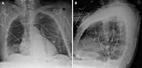 Posteroanterior A And Lateral B Admission Chest Radiograph