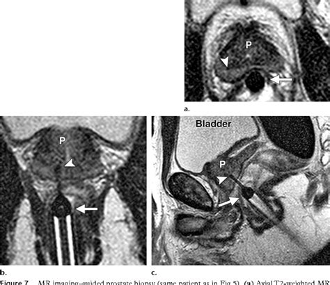 Pdf Imaging Guided Prostate Biopsy Conventional And Emerging Techniques Semantic Scholar