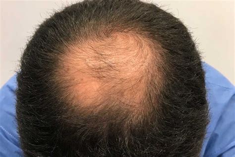 La Alopecia Androg Nica En Hombres Caracter Sticas Y Soluciones Dr