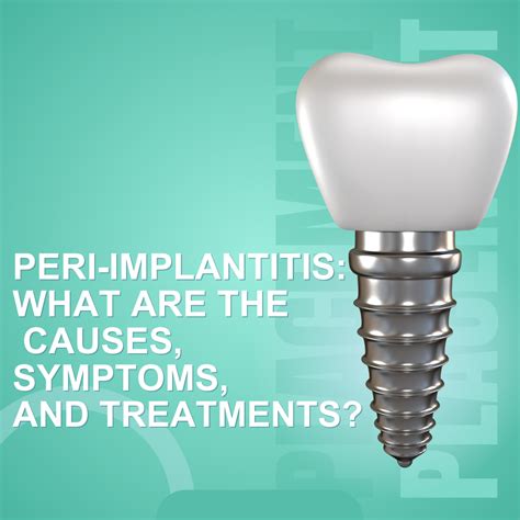 Peri Implantitis What Are The Causes Symptoms And Treatments Best