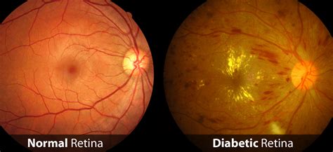 Diabetic Eye Checkup Get Your Comprehensive Diabetic Eye Test