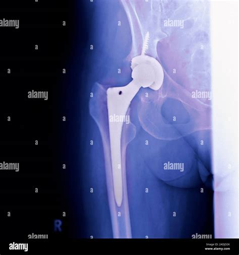 Total Hip Replacement Coloured Frontal X Ray Of The Right Leg And