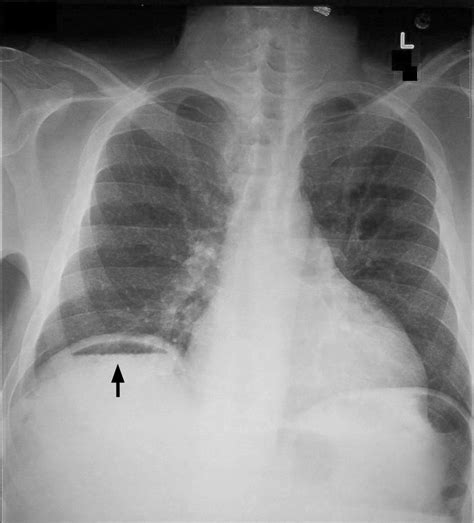 Chest X Ray Interpretation A Structured Approach Radiology Osce