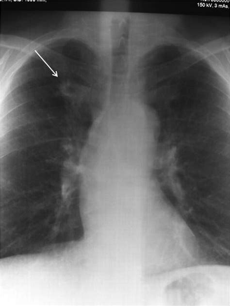 Arthritis Nodules On Lungs