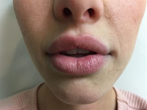 Lip Fillers Sydney Au My Cosmetic Clinic