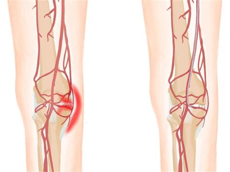 Genicular Artery Embolization Gae Interventional Radiology Located