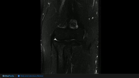 Elbow Medial Ulnar Collateral Ligament Ucl Injuries Literature