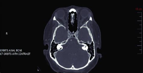 CT Scan Of Orbits With Contrast Was Unremarkable Without Orbital Tissue