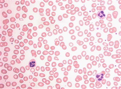 Pernicious Anemia
