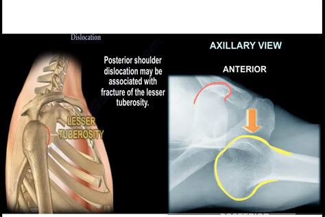 Posterior Shoulder Dislocation OrthopaedicPrinciples