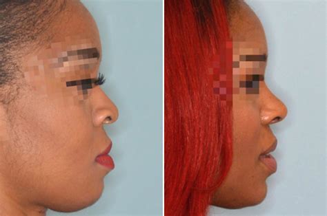 Ethnic Rhinoplasty Photos Miami Fl Patient 1035