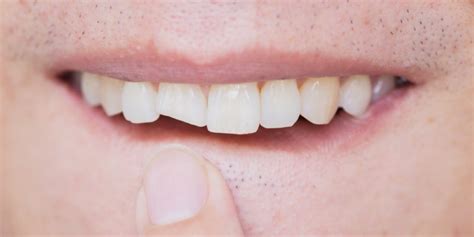 Types of Broken Teeth – Broken Teeth