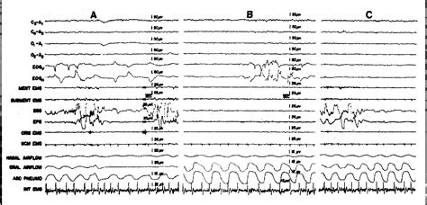 Figure From Phasic Tongue Movements In Human Rapideyemovement Sleep