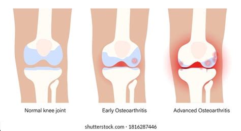 Synovitis Knee Closeup Joint Inflammation Synovial Stock Vector