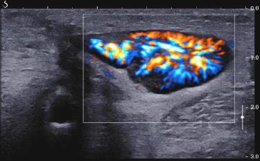 (Ch:30) Ultrasound of lymph nodes – EFSUMB