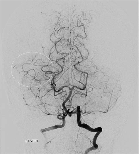 Anterior Choroidal Artery | neuroangio.org