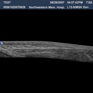 A Transverse View Of The Proximal Long Head Of The Biceps In The