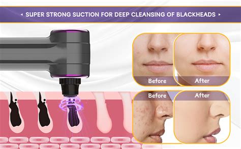 Amazon BENTFINE Blackhead Remover Vacuum 2 In 1 Facial Pore