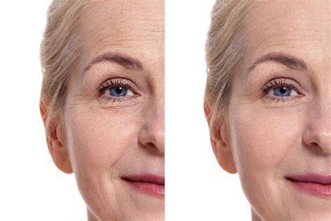 Platelet Rich Fibrin Facial Benefits And What To Expect