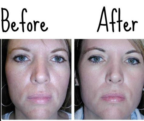 Before And After Using Vaseline For Wrinkles Erase Wrinkles Vaseline For Face Vaseline Uses