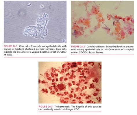 Bacterial Vaginosis BV Vulvovaginal Candidiasis Trichomonas