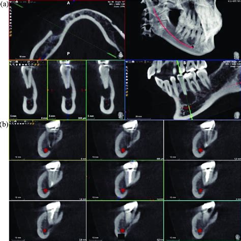 Pdf Applications Of Cbct In Endodontics