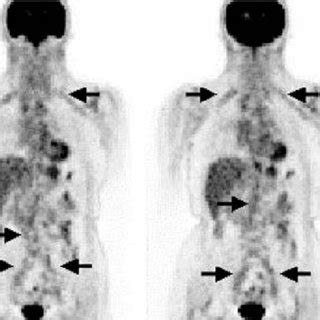 A Year Old Man With Biopsy Proven Lung Cancer Was Explored For