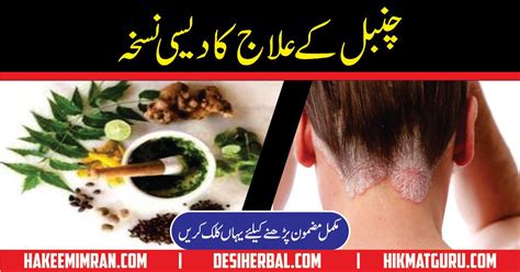 Chambal Ka Ilaj Psoriasis Causes Treatment In Urdu Desi Herbal