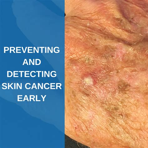 Preventing And Detecting Skin Cancer Early Savannah River Dermatology