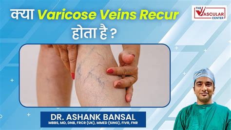 Can Varicose Veins Reoccur Post Treatment By Dr Ashank Bansal YouTube