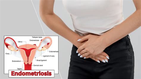 Endometriosis A Complex And Painful Condition Gaudium IVF And Women