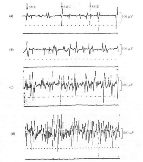 5 Normal Dorsal Interosseous Muscle Under Different Degrees Of