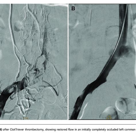 Case 3 Before And After Iliac Vein Venography Download Scientific