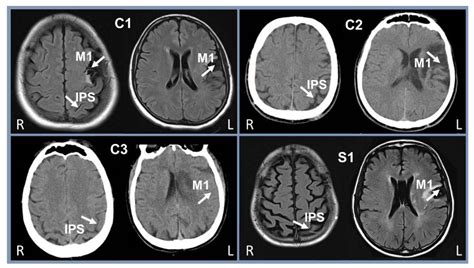 Intraparietal Sulcus Mri