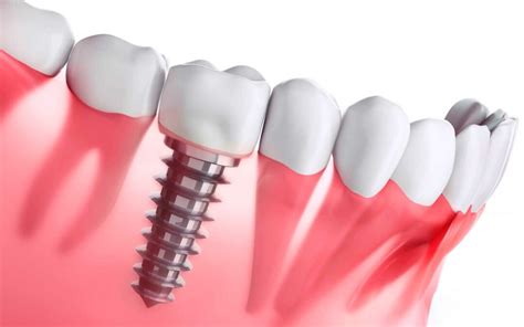 Implantes O Puentes Dentales Qu Es Mejor Para M Clinica Dental