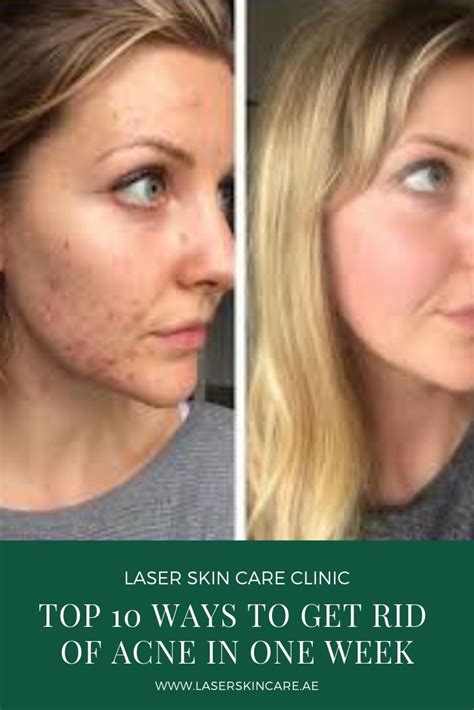 Top 10 Ways To Get Rid Of Acne In One Week Laser Skin Care