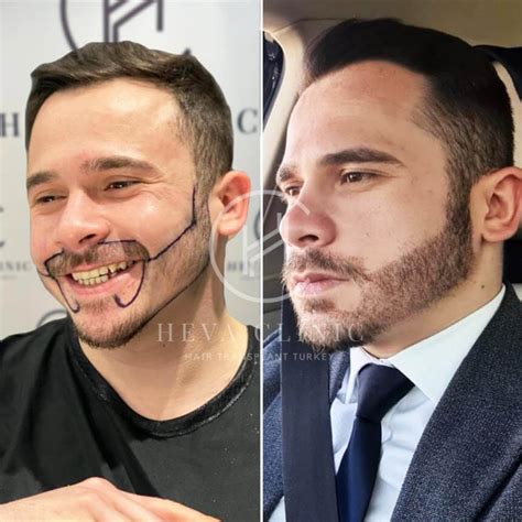 arnett hair transplant hair loss technical analysis