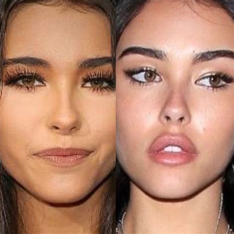 Madison Beer Plastic Surgery Eye Lift Surgery Lip Fillers Eyebrow Lift