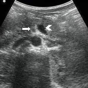 Axial Contrast Enhanced Ct Scan Image Showing The Whirlpool Sign Arrow