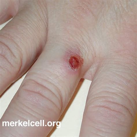 Clinical Photos Of Merkel Cell Carcinoma