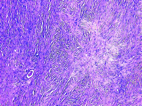 B Histology Hande Fibroma Formed By Fibrocytes And Collagen Fibers Download Scientific