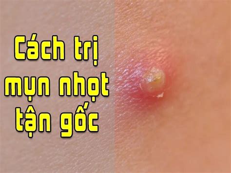 Tìm Hiểu Cách Trị Mụn Nhọt ở Mông Bằng Kem đánh Răng