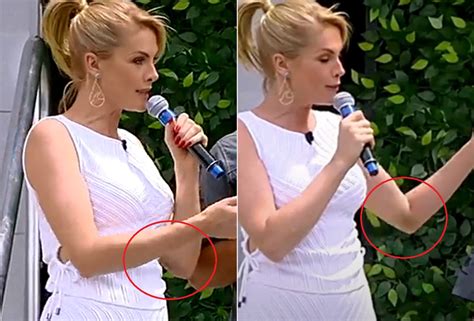 Ana Hickmann apresentou programa hematoma no braço vídeo