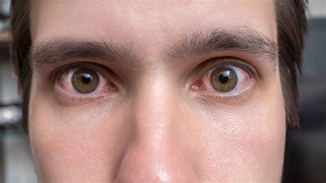 Allergic Conjunctivitis: Causes, Symptoms, Diagnosis, Treatment ...