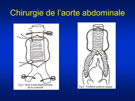 PPT La Chirurgie Cardiovasculaire PowerPoint Presentation Free