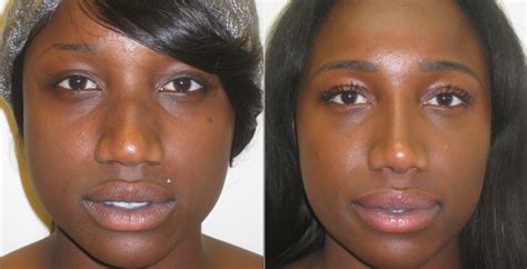 Rhinoplasty Before & After Photos