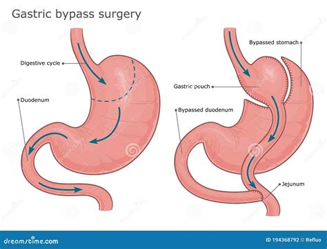 Gastric Bypass Surgery Stock Vector Illustration Of Diagram 194368792