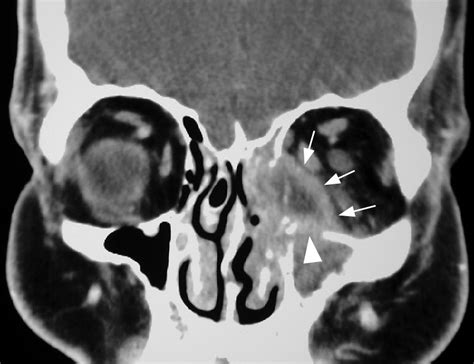 Imaging Features Of Invasive And Noninvasive Fungal Sinusitis A Review