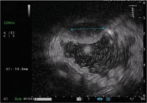 Eus Showed One 2 Cm Heterogeneous Hypoechoic Tumor Originating From The Download Scientific