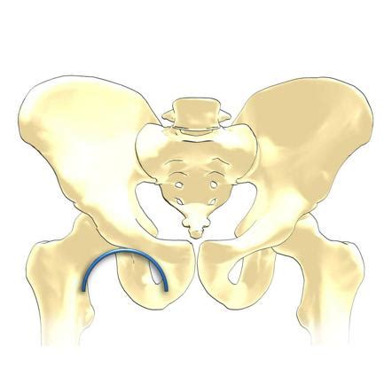 Shenton Line Radiology Reference Article Radiopaedia Org